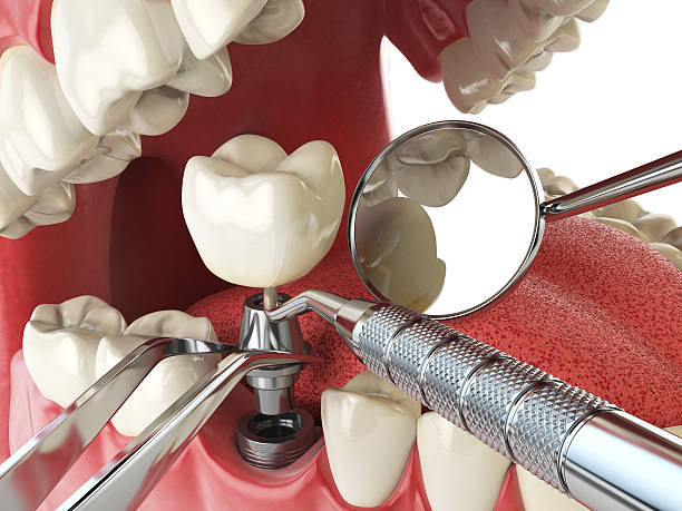 Best Lost Filling or Crown Replacement in Trenton, TN